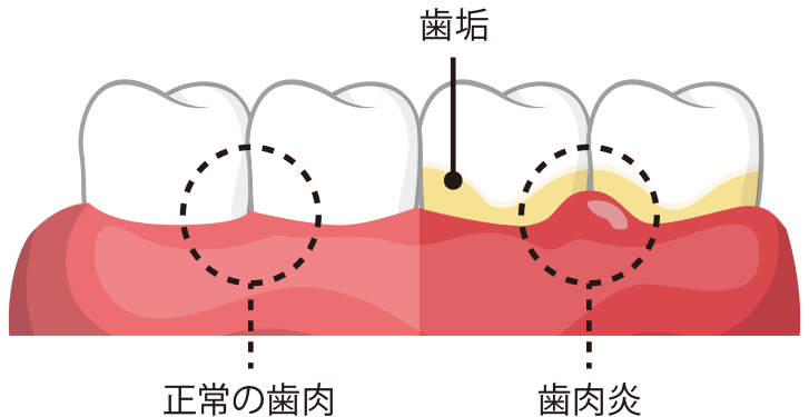 思春期のお口の変化