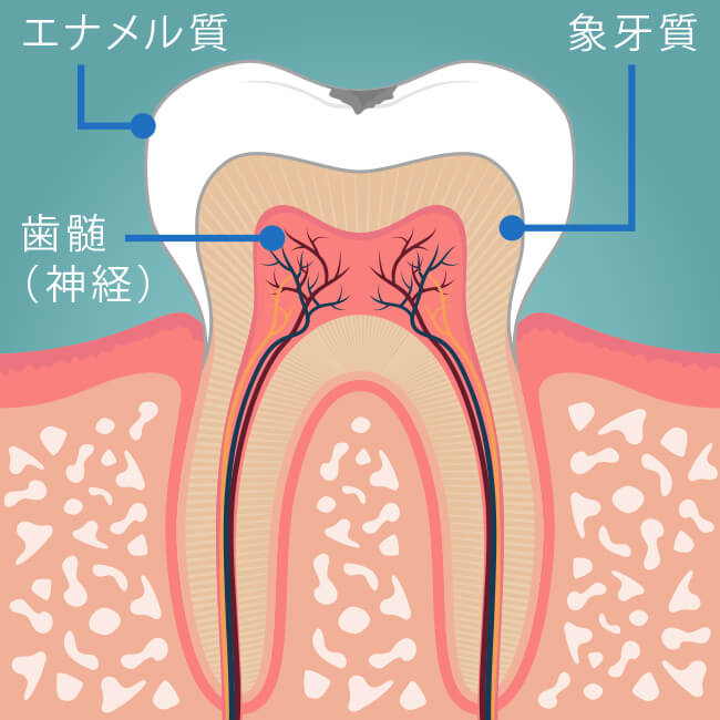 Ｃ1（う蝕第1度）