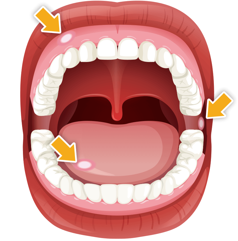 歯茎 の 奥 口内炎