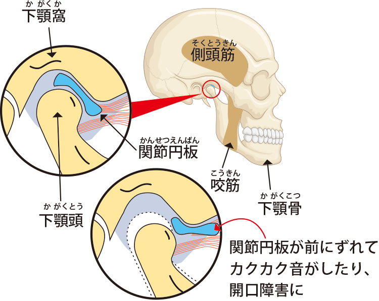 顎関節症の構造と病態