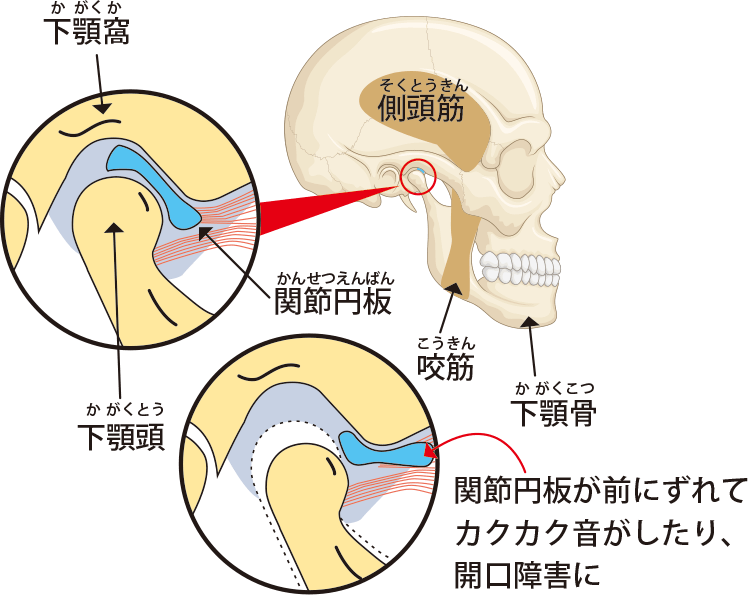 顎関節症は他の健康上の問題を引き起こす可能性がありますか?