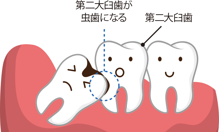 親知らずが原因となるトラブルは？