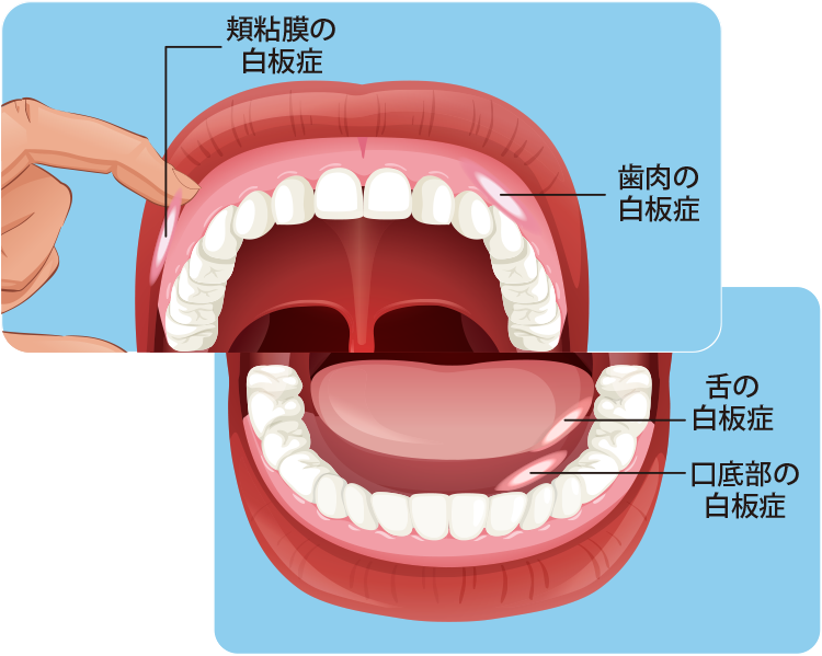 症状の現れ方―前がん病変