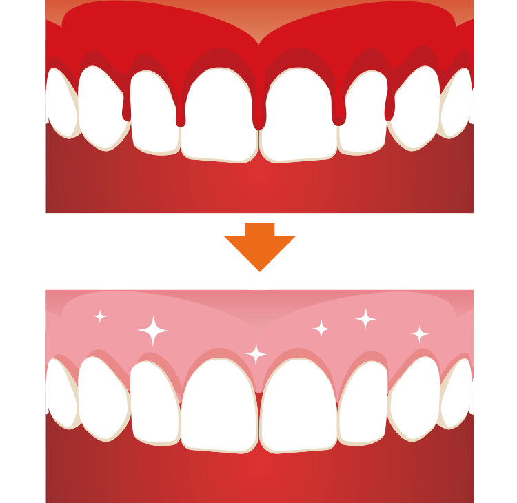 歯間清掃で歯肉が引き締まる